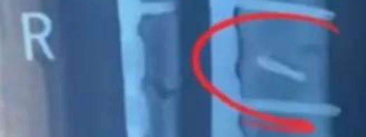 手术室惊魂：钻头遗落体内，医院竟称“影响不大”隐瞒数月！